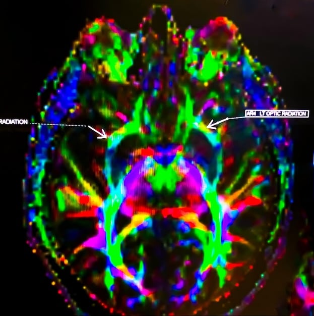 A close-up of brain scan imagery highlighting areas associated with stress reduction and emotional regulation during meditation practice.